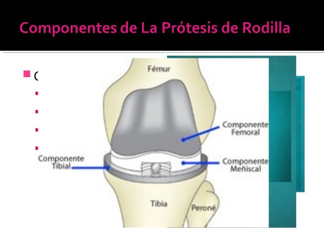 Artroplastia Parcial De Rodilla Pdf